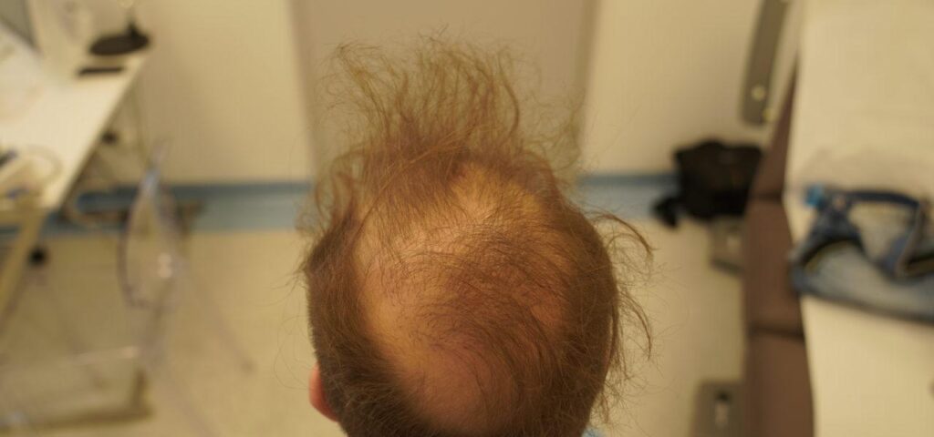 efekt nieudanego przeszczepu włosów metodą STRIP