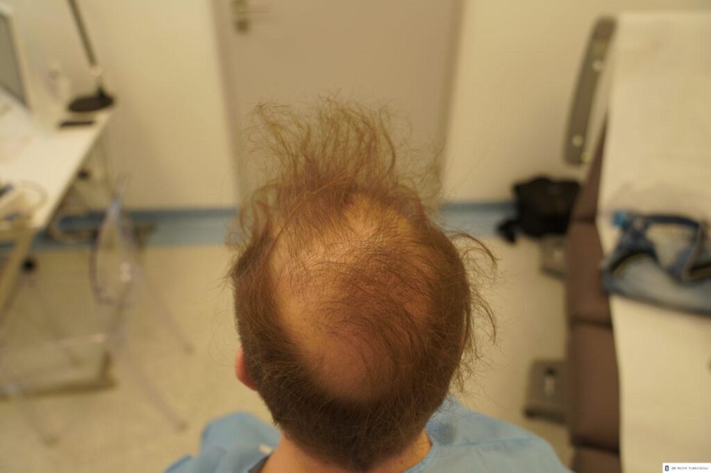 the effect of a failed fut - strip hair transplant