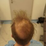 efekt nieudanego przeszczepu włosów metodą fut strip