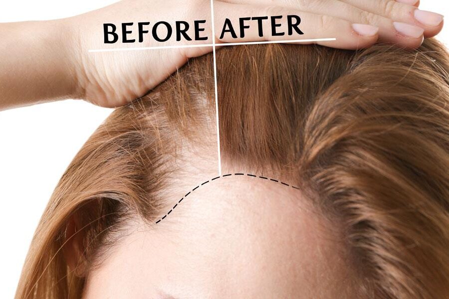 przeszczep włosów u kobiet