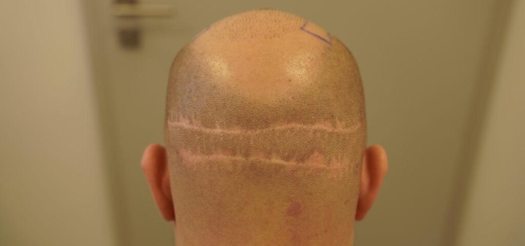 visible scar after taking the strip in the donor area