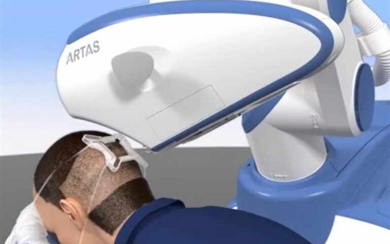 ARTAS robotic hair transplant system