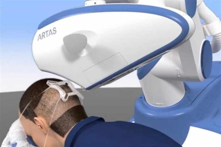 Robot do transplantacji włosów ARTAS