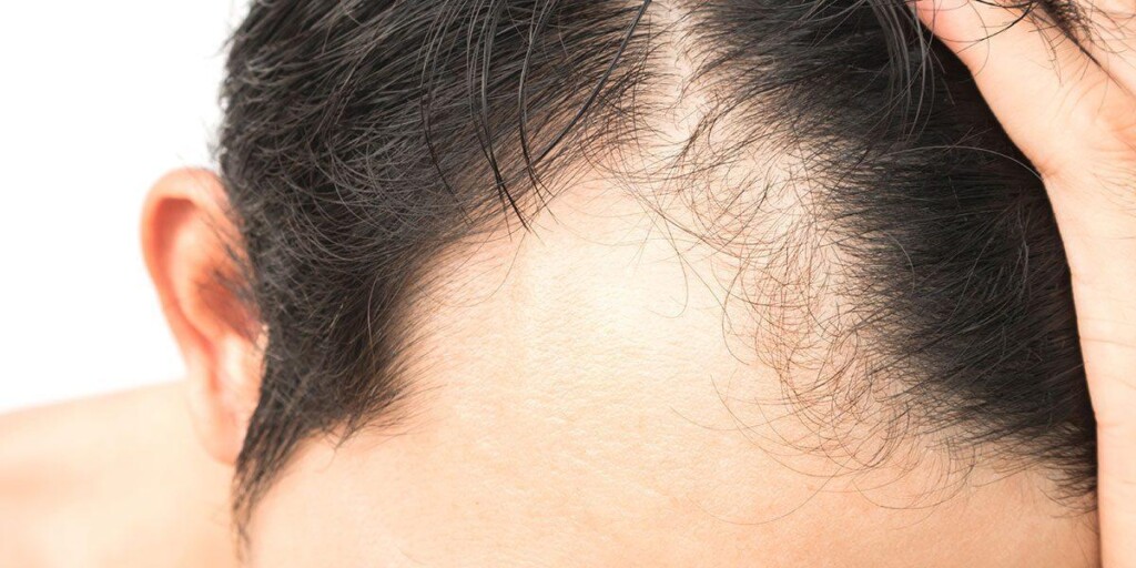 androgenetic alopecia