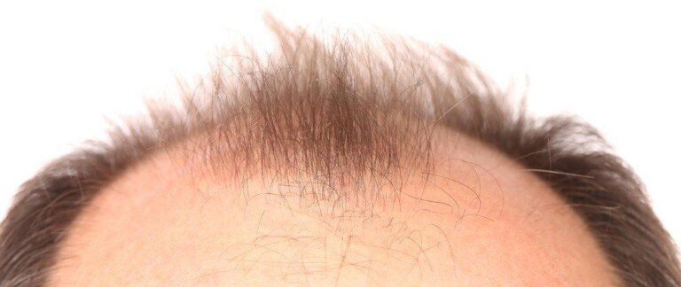 treatment of baldness