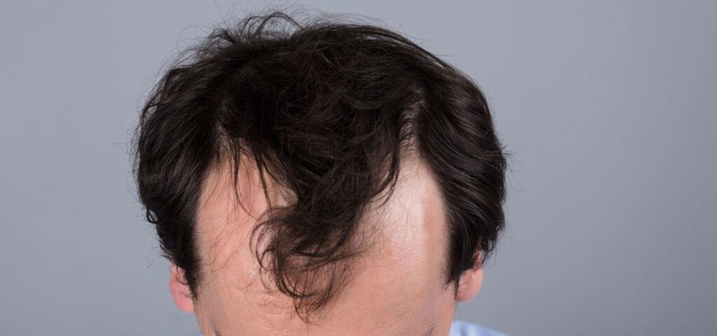 Androgenetic alopecia - treatment, diet - Dr Piotr Turkowski