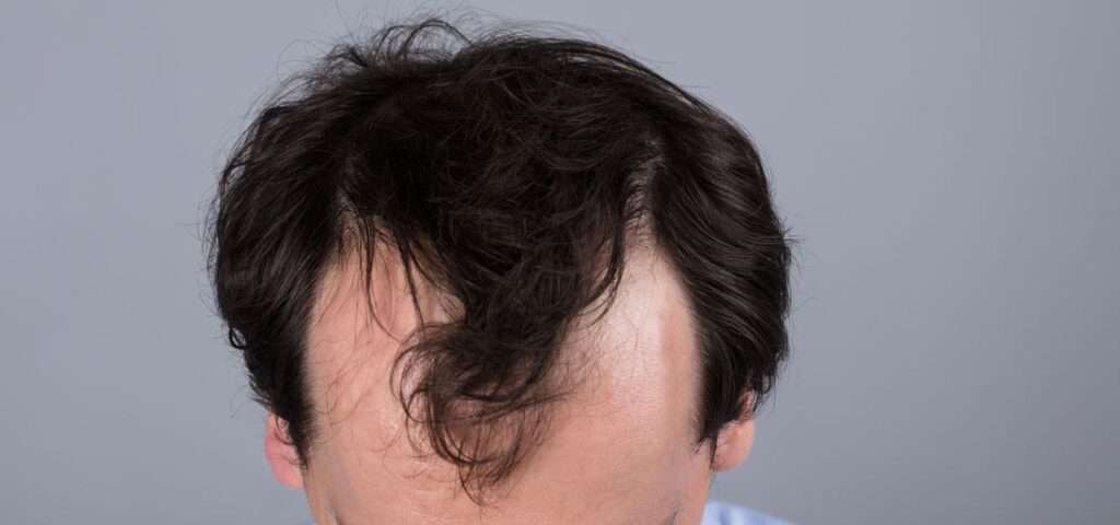 androgenetic alopecia