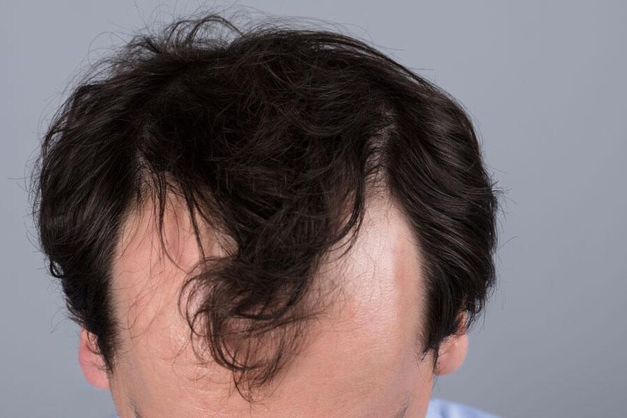 androgenetische Alopezie