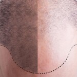 hair transplant artas hair transplant fue