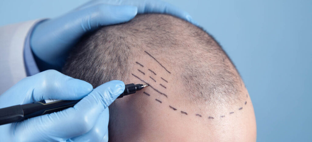 How to prepare for a hair transplant procedure?