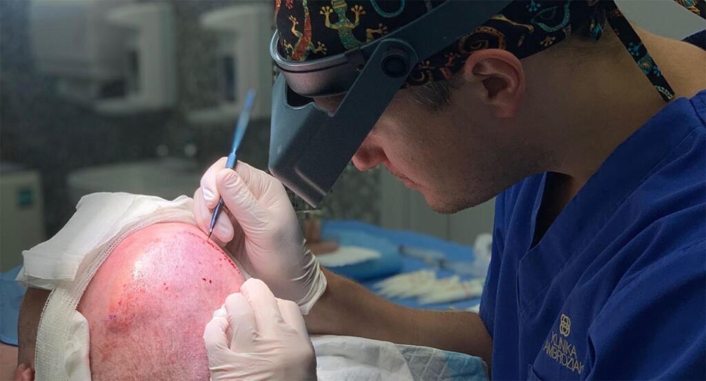 ARTAS czy FUE – jaką metodę przeszczepu włosów wybrać?
