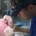 przeszczep włosów metodą artas czy fue