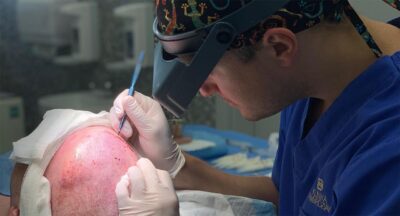 przeszczep włosów metodą artas czy fue