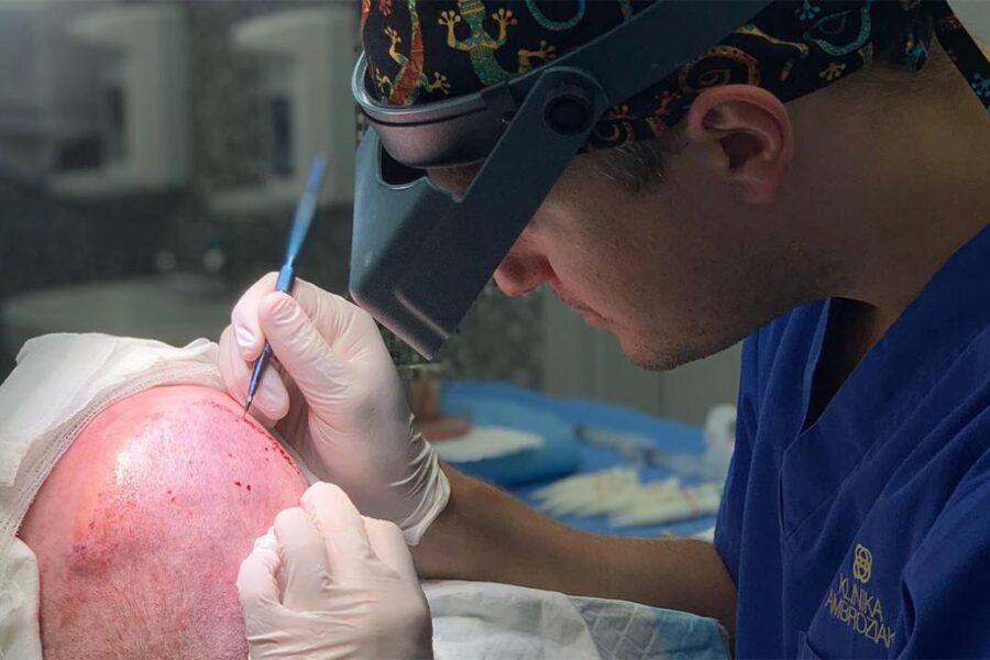 przeszczep włosów metodą artas czy fue