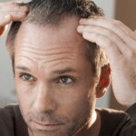 widoczne zakola u mężczyzny