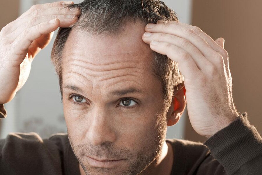 widoczne zakola u mężczyzny