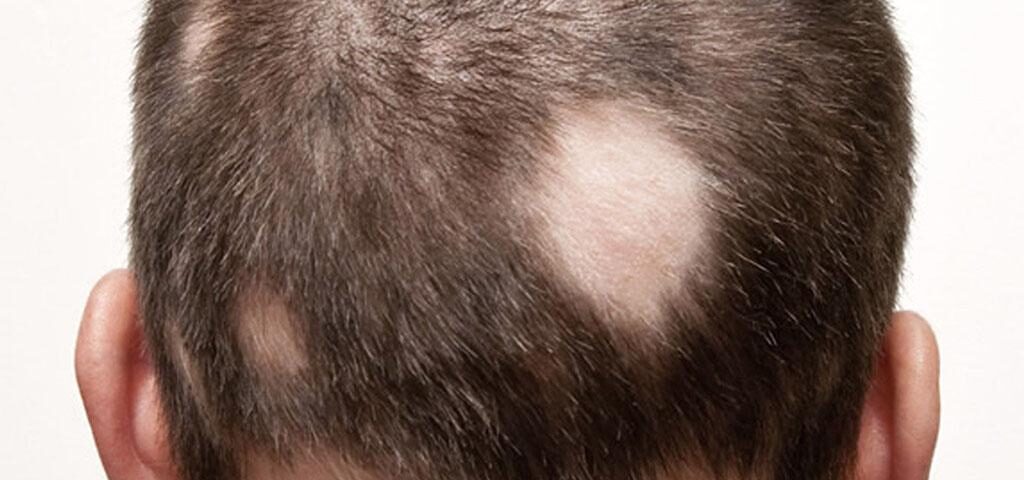 łysienie plackowate