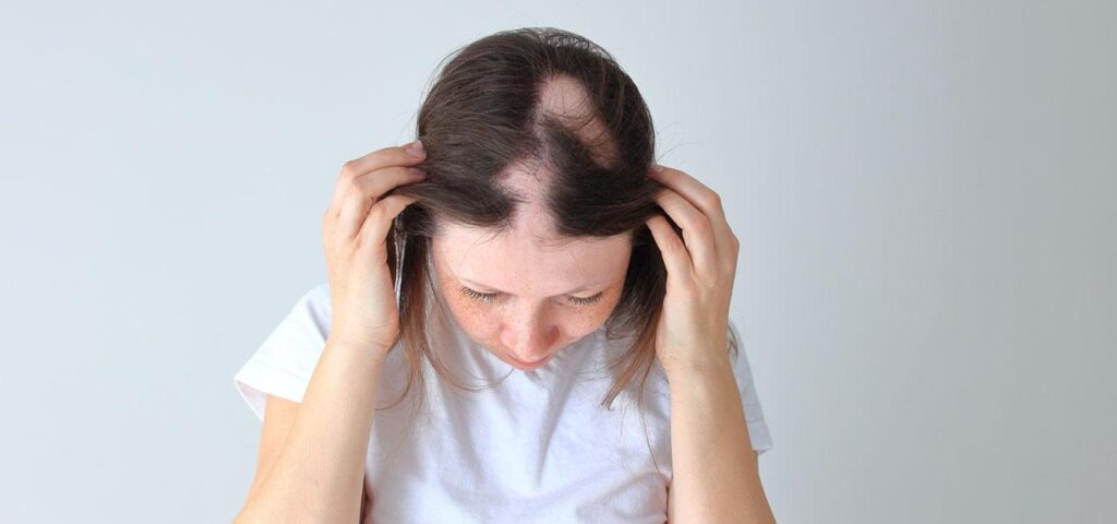 alopecia areata in a woman