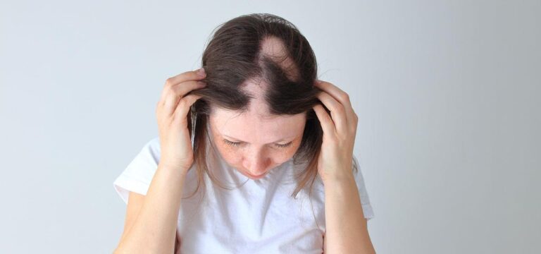 alopecia areata in women