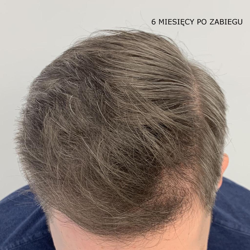po zabiegu przeszczepu wlosow1