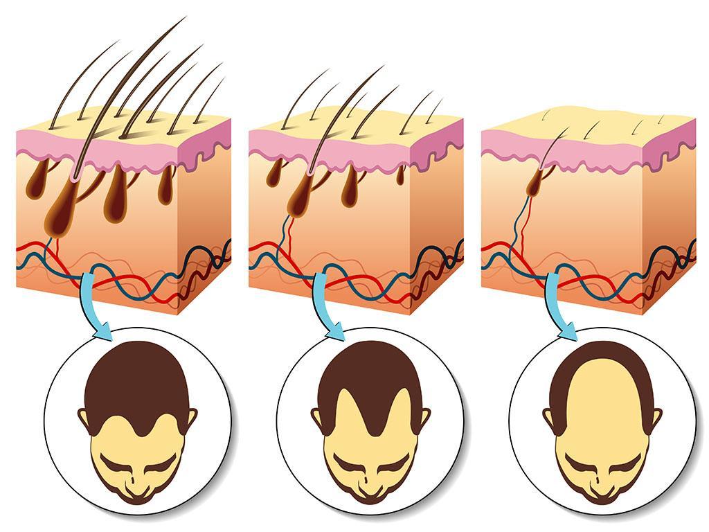 the process of hair loss