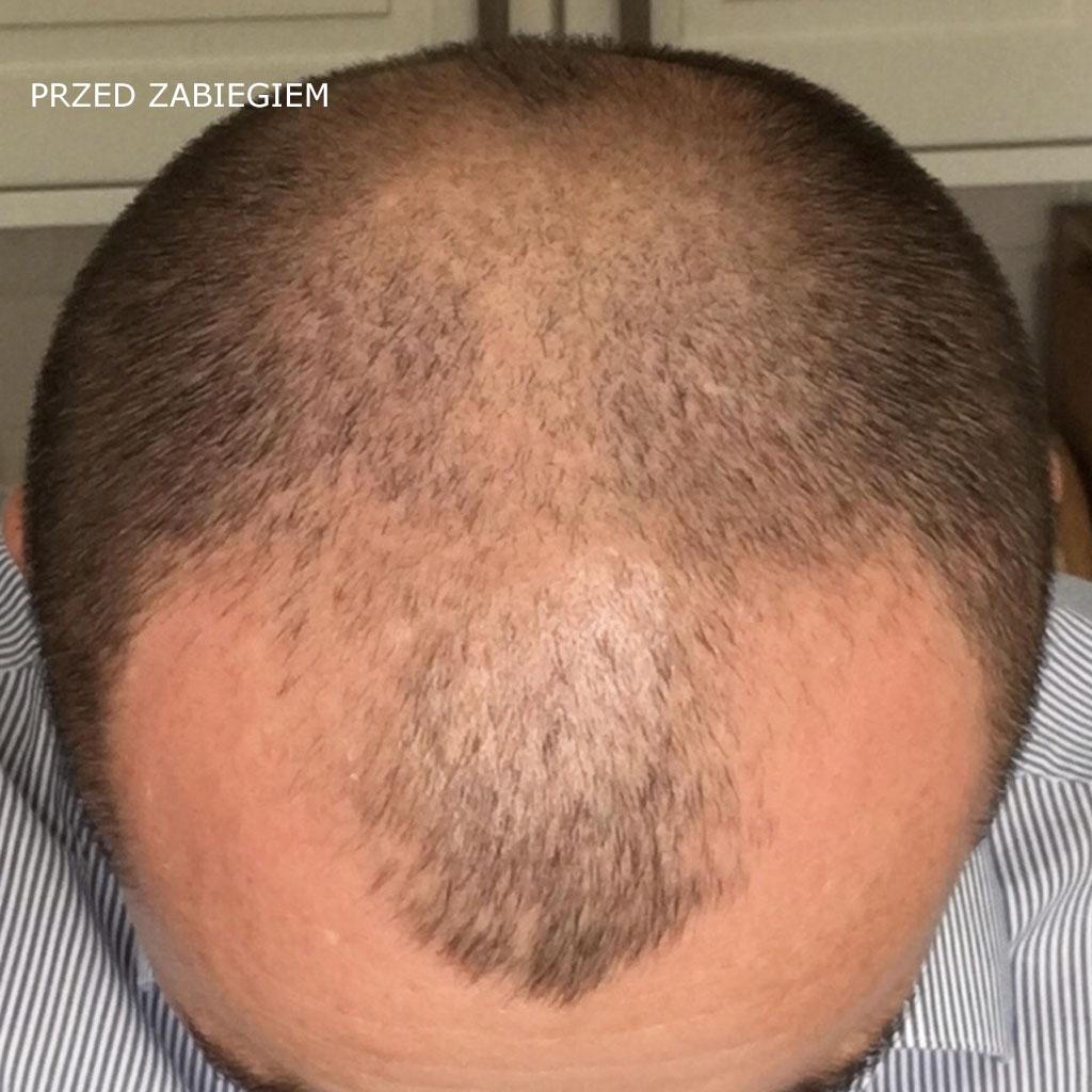 przed zabiegiem przeszczepu wlosow