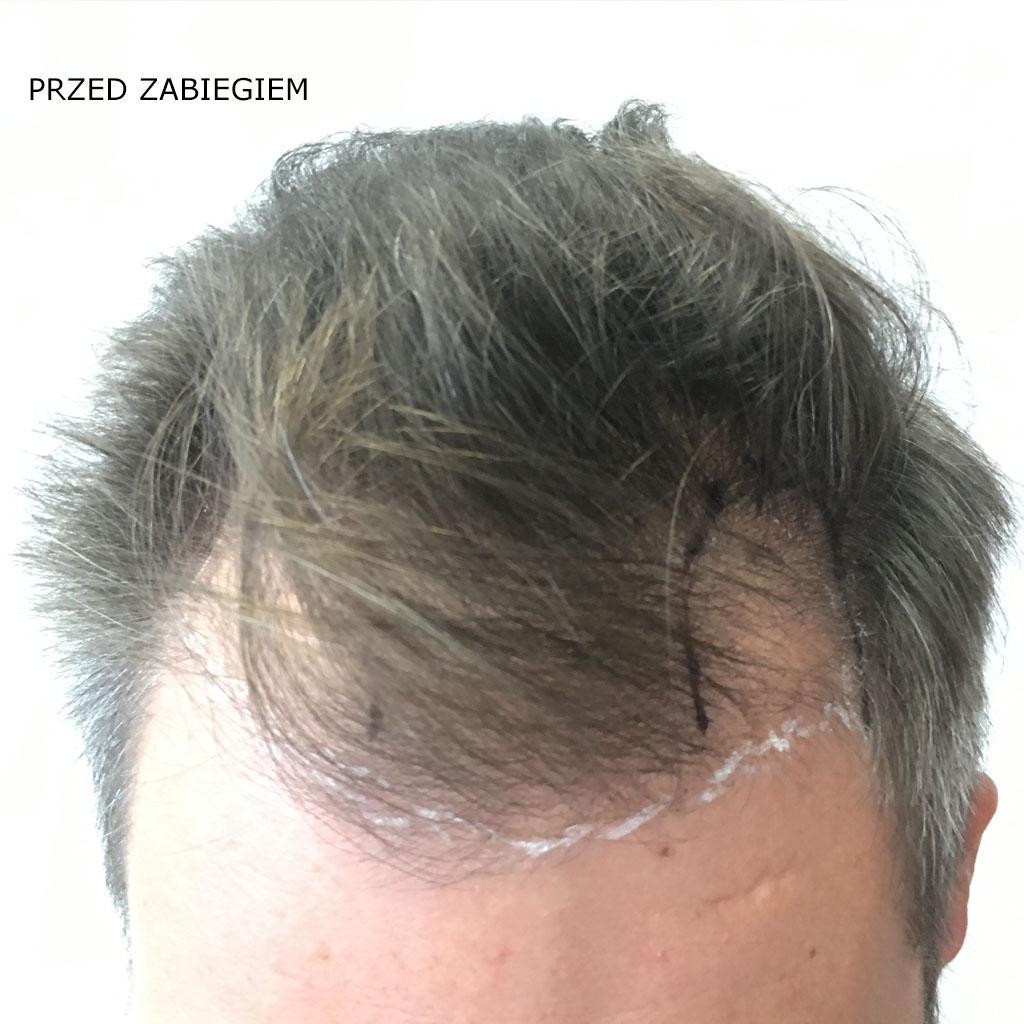 przed zabiegiem przeszczepu wlosow1