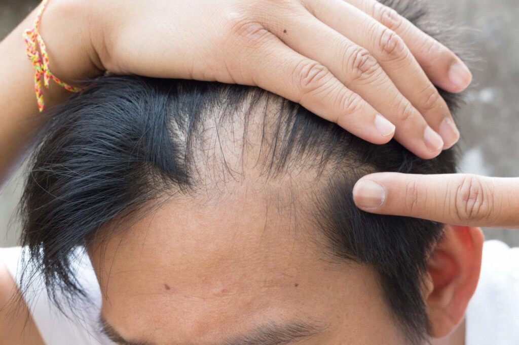 hair loss, alopecia areata