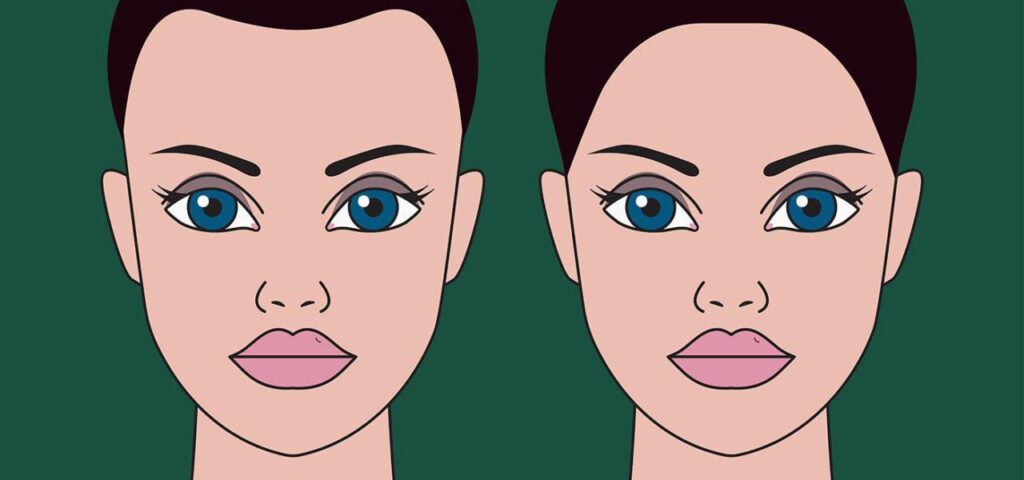 Hair transplant for women with receding hairlines Hair transplant for women with receding hairlines