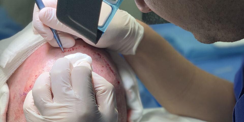 Ablauf der Haartransplantation