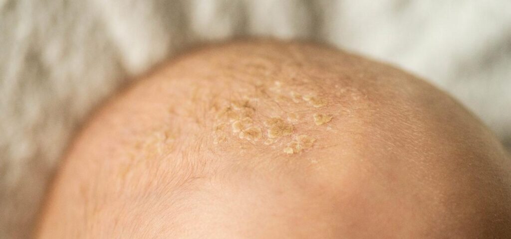 seborrhoeic dermatitis in babies