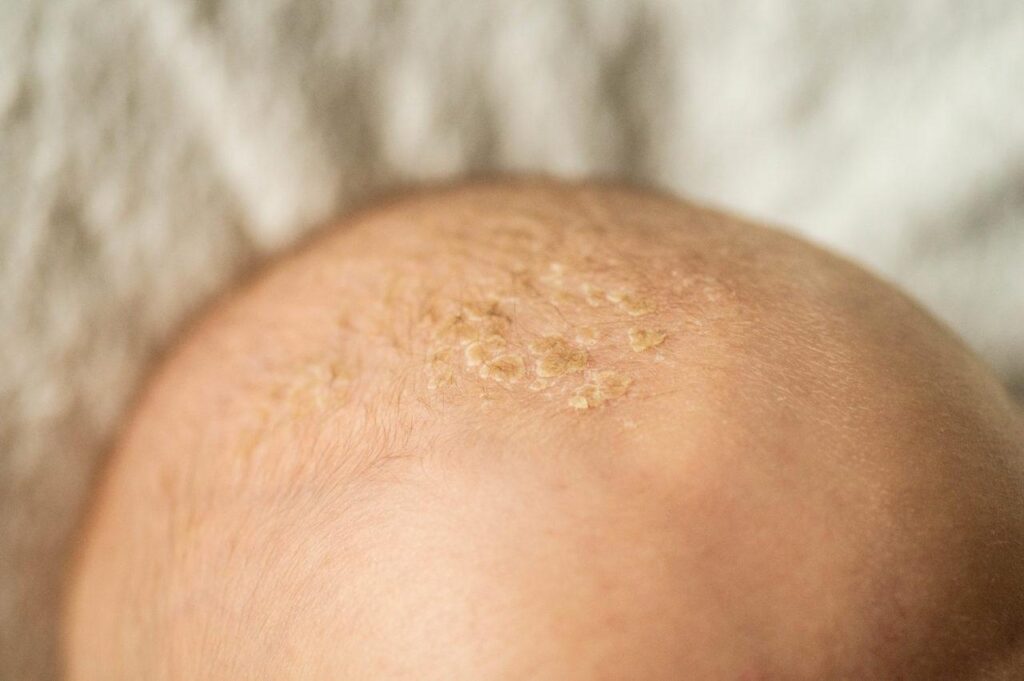 Łojotokowe zapalenie skóry głowy u niemowląt