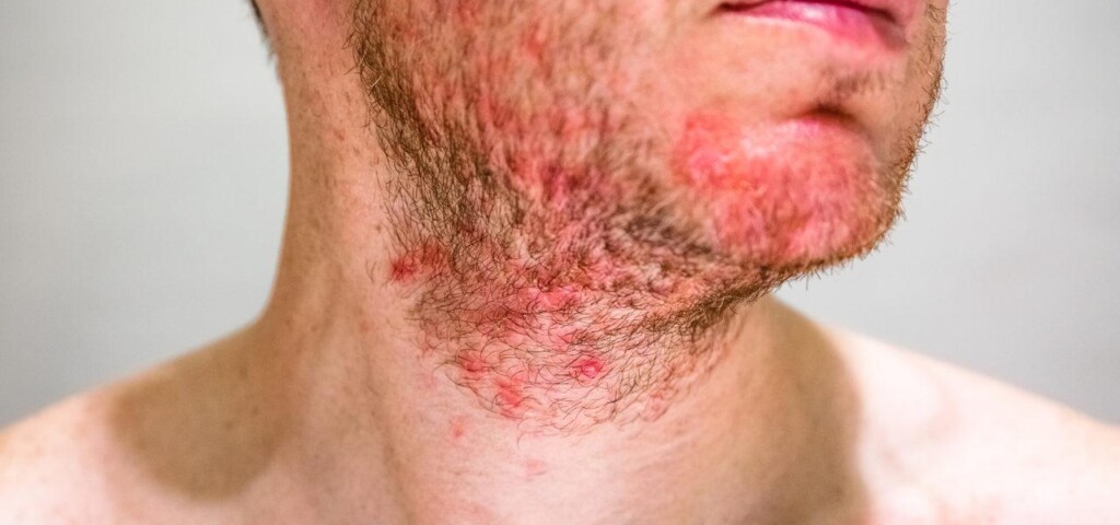 Łojotokowe zapalenie skóry w okolicach brody