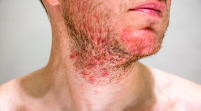Łojotokowe zapalenie skóry w okolicach brody