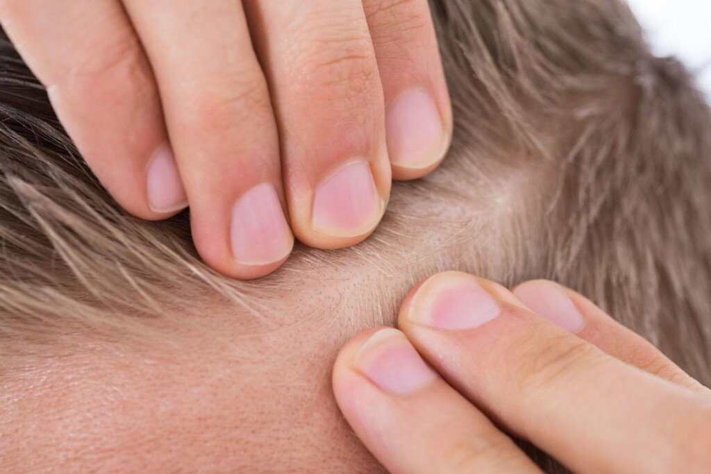 seborrhoeic dermatitis