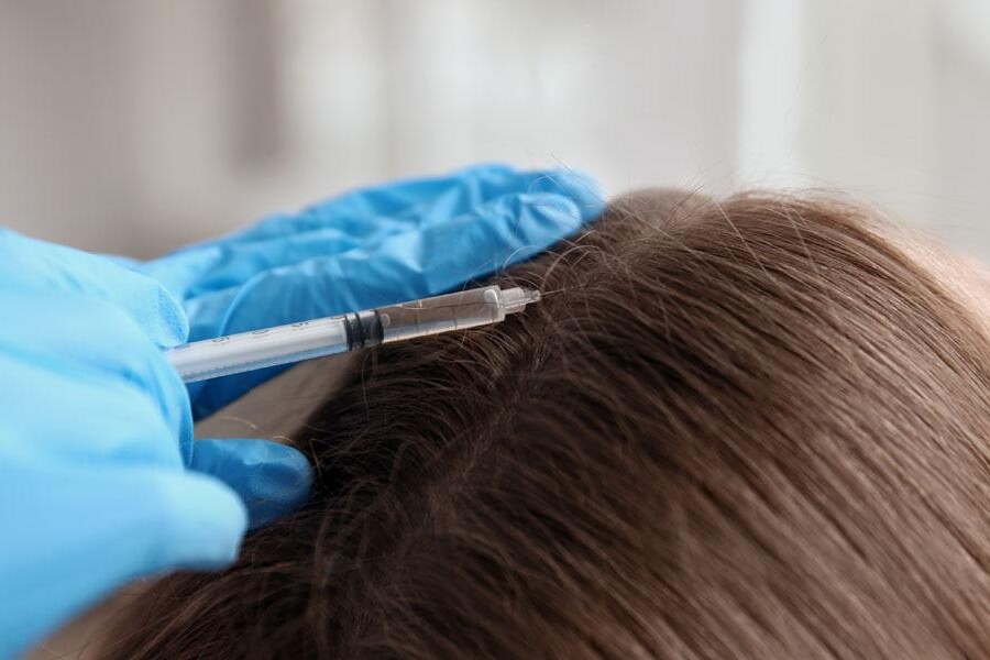 Mezoterapia iglowa glowy