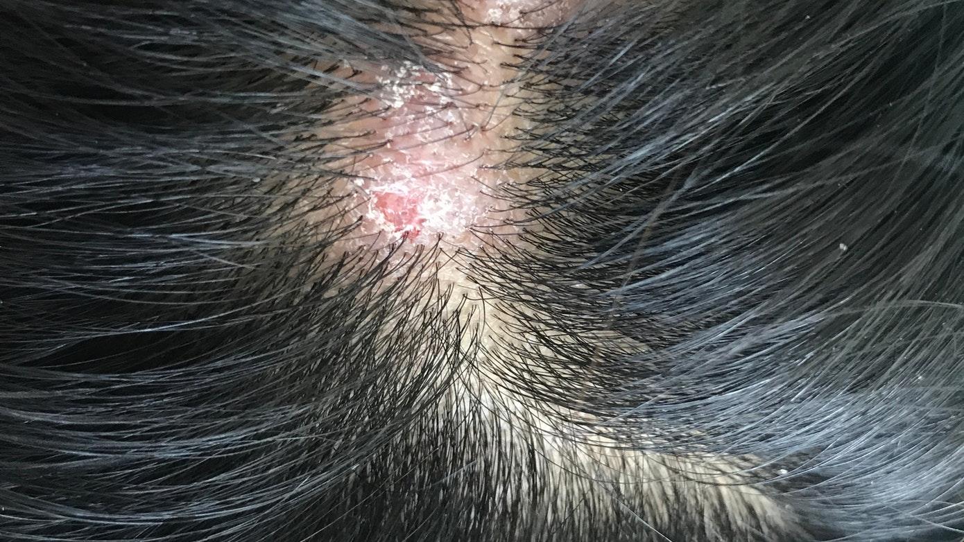 Pimples and scabs on the head – cause | Dr Piotr Turkowski