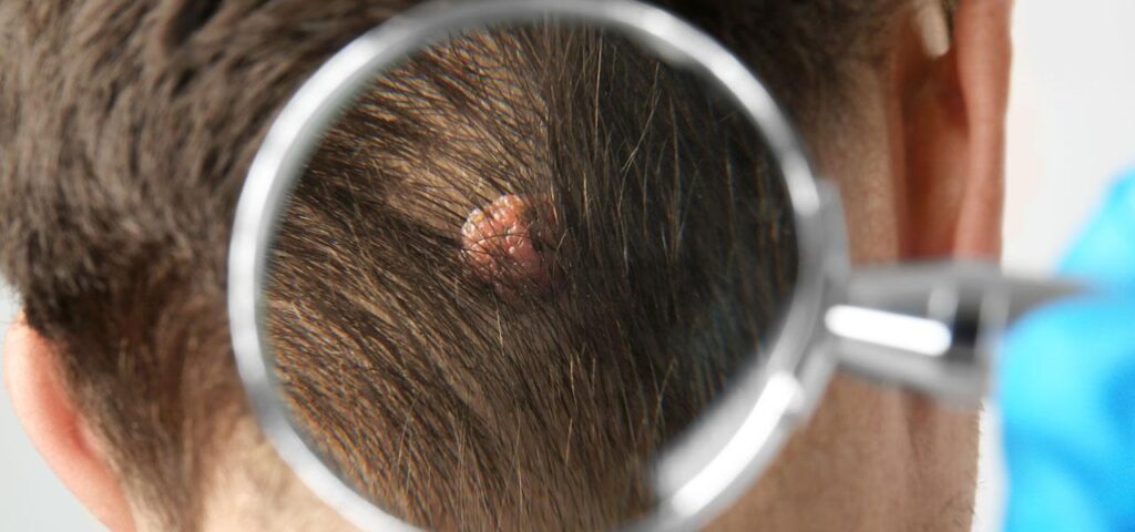 Pimples and scabs on the head. Causes, prevention