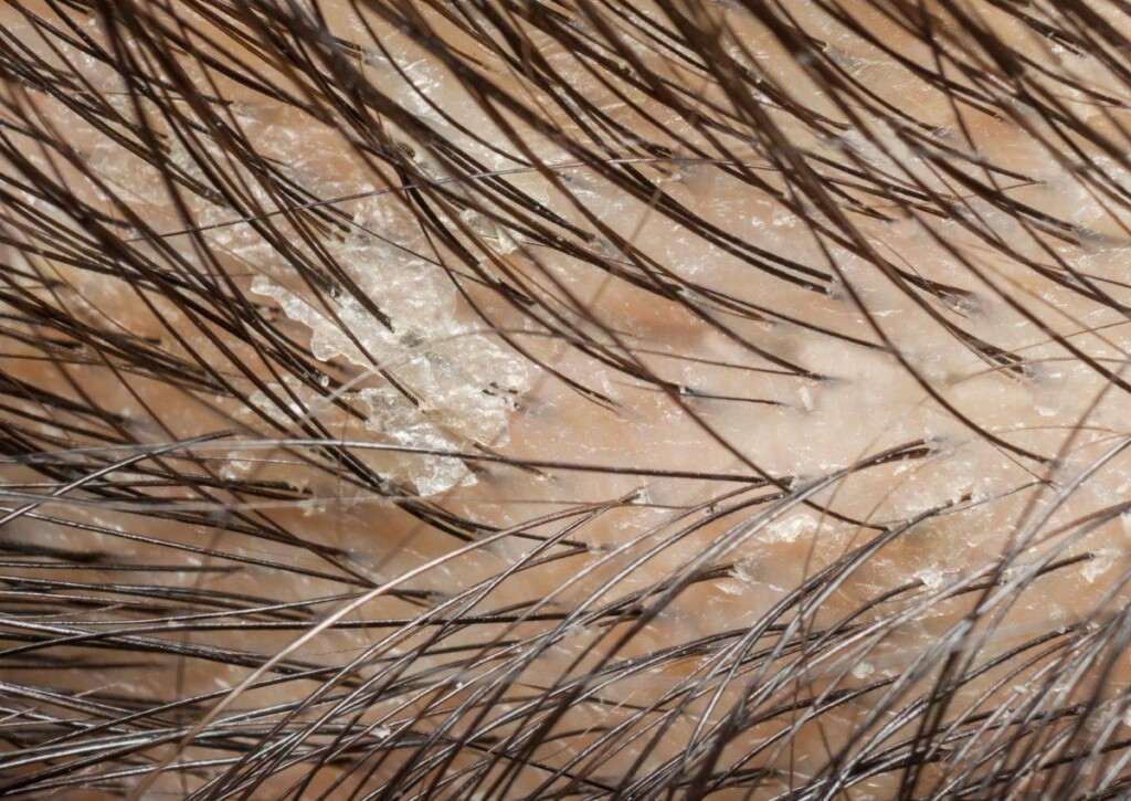 The 3 most common scalp diseases • Dr Piotr Turkowski