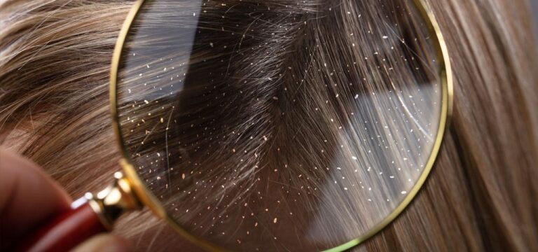 Dandruff causes symptoms types and treatment