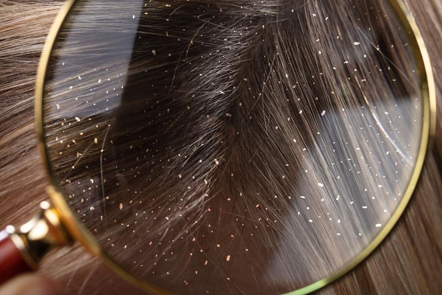 Schuppen verursachen Symptome, Arten und Behandlung