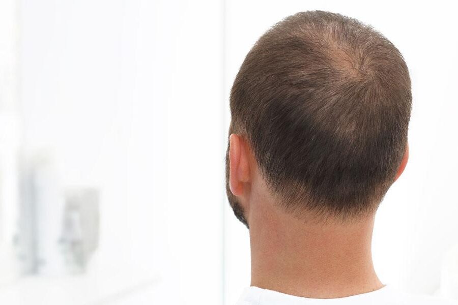 Łysienie telogenowe