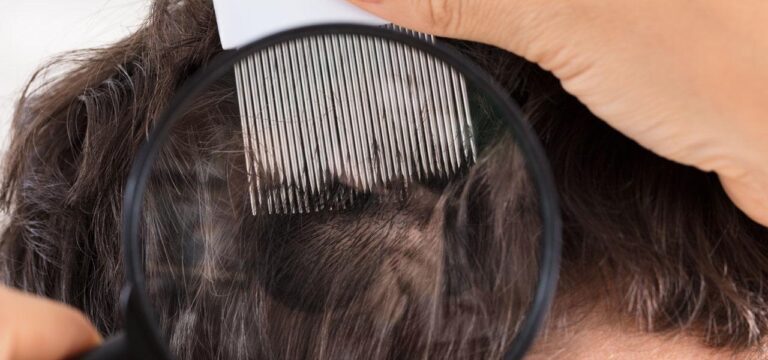 scalp diseases