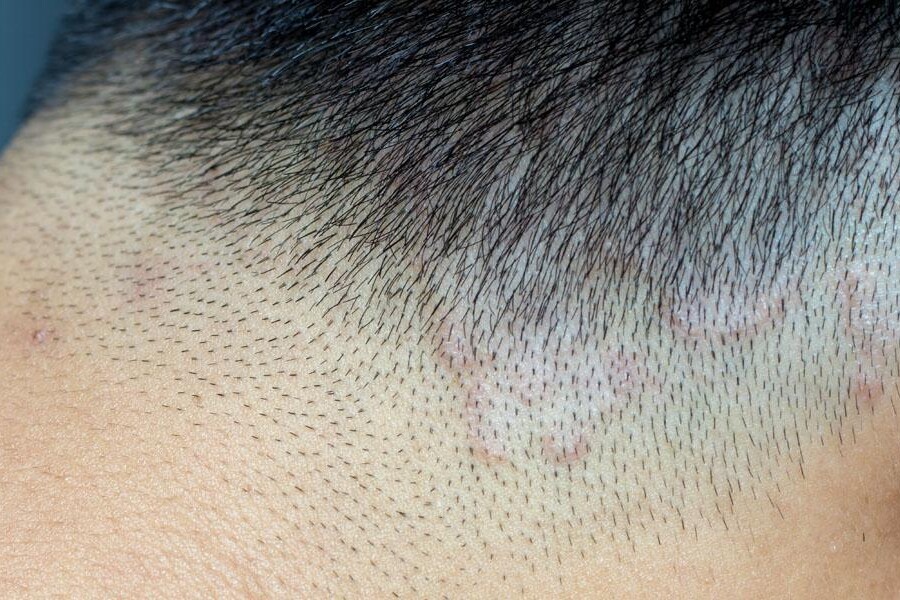 grzybica skóry głowy