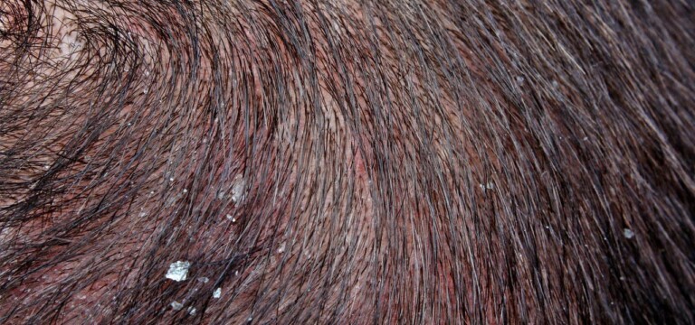 Dandruff - Causes, Symptoms, Treatment