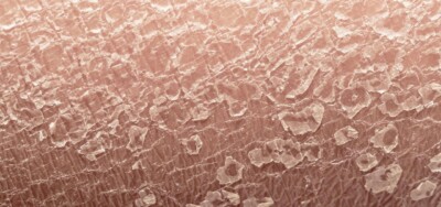 Łuszczyca skóry głowy