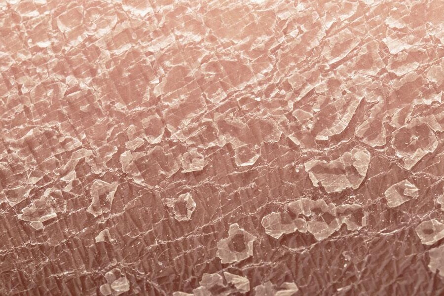 Łuszczyca skóry głowy