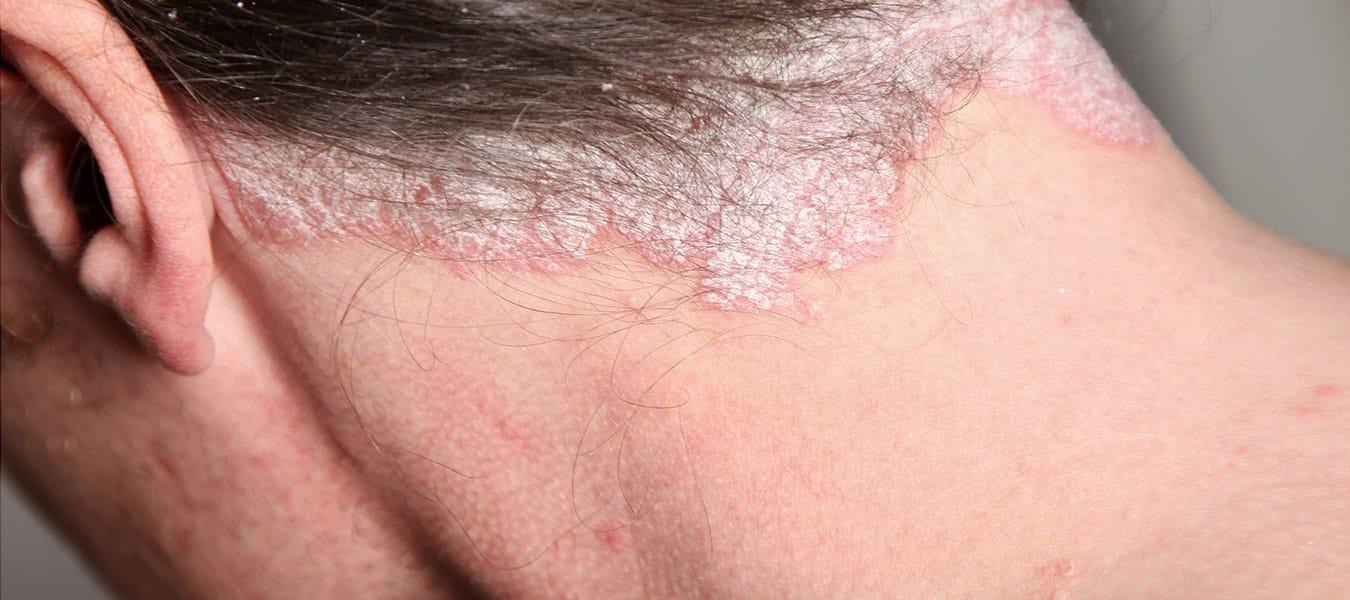 Scalp Psoriasis Symptoms And Treatment • Dr Piotr Turkowski