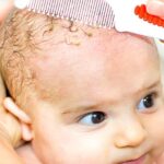 ciemieniucha u dziecka