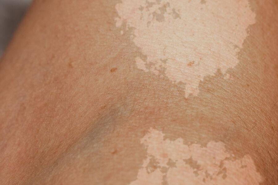 lupiez pstry na dloni